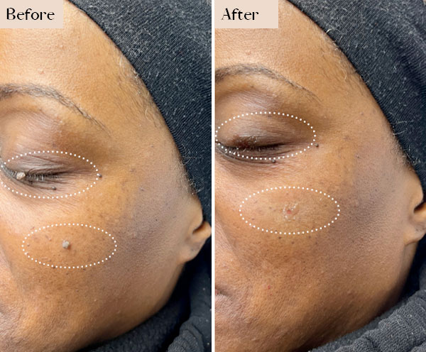 mole removal before after manhatttan nyc
